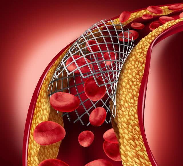 心脏支架进入百元时代 心血管治疗的生态彻底变了